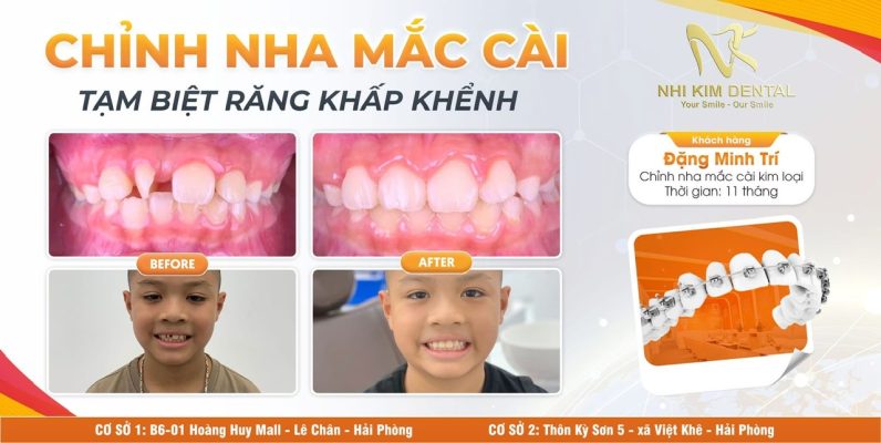 ĐẶNG MINH TRÍ, CHỈNH NHA 1 HÀM DO RĂNG CỬA 12 XOAY TRỤC