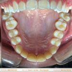 3 điều cần biết về trám răng thẩm mỹ 416311419_351709947615211_6303027972634439806_n