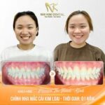 Trường hợp nên và không nên bọc răng sứ 440322937_424441283675410_151349597446753858_n