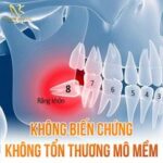 Những điều cần biết về cắt lợi trùm 440351905_419735424145996_5572997947844806201_n
