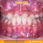 Bọc răng sứ có đau không? 451574677_465584626227742_2176903454904336013_n