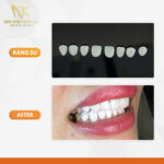 Bọc Răng Sứ Thẩm Mỹ – Giải Pháp Tái Tạo Nụ Cười Hoàn Hảo z6309747775826_8a390ced35ac9f1b7e0e25d301e16f72 - Sao chép