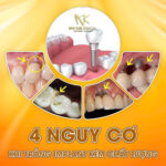 Các Loại Trụ Implant: Lựa Chọn Nào Phù Hợp Nhất Cho Bạn? các loại trụ implant
