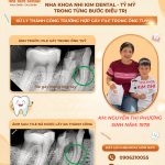 hình ảnh file gẫy trong ống tủy của cô Nguyễn Thị Phương được lấy ra thành công.