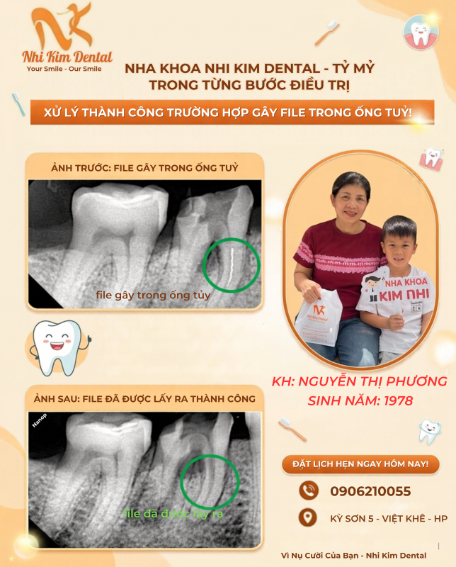 hình ảnh file gẫy trong ống tủy của cô Nguyễn Thị Phương được lấy ra thành công.