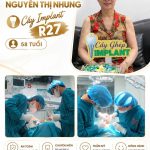 Cô Nhung cấy ghép implant R27