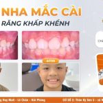 ĐẶNG MINH TRÍ, CHỈNH NHA 1 HÀM DO RĂNG CỬA 12 XOAY TRỤC