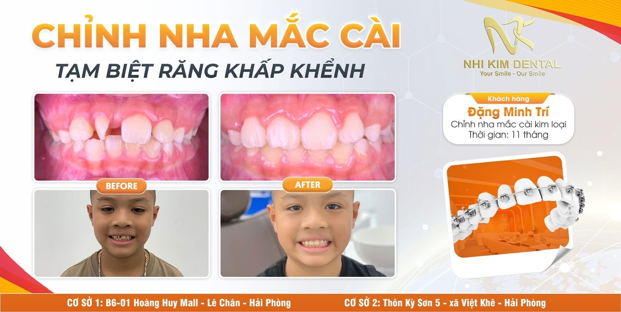 ĐẶNG MINH TRÍ, CHỈNH NHA 1 HÀM DO RĂNG CỬA 12 XOAY TRỤC