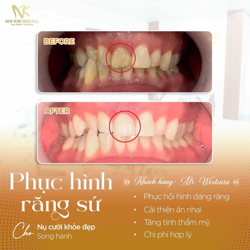 PHỤC HÌNH RĂNG