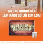 Tại Sao Không Nên Làm Răng Sứ Lõi Kim Loại? 5 Hạn Chế Cần Biết