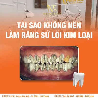 Tại Sao Không Nên Làm Răng Sứ Lõi Kim Loại? 5 Hạn Chế Cần Biết