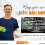 Thầy Đào Phương Hà cấy Implant R16,17