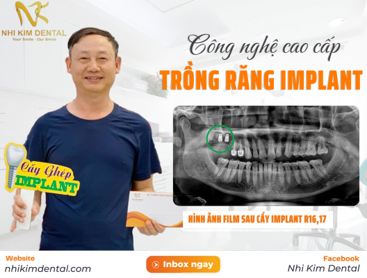 Thầy Đào Phương Hà cấy Implant R16,17